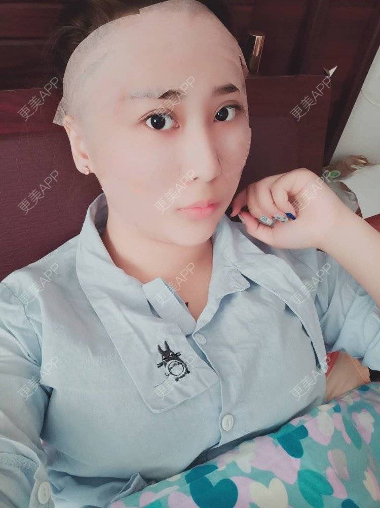 更美 - 更美用户IJkbsLYbyo的自体脂肪丰面颊经验 | 自体脂肪丰面颊 | 自体脂肪丰太阳穴 | 自体脂肪丰额头 | 合肥 | 自体脂肪全面部填充