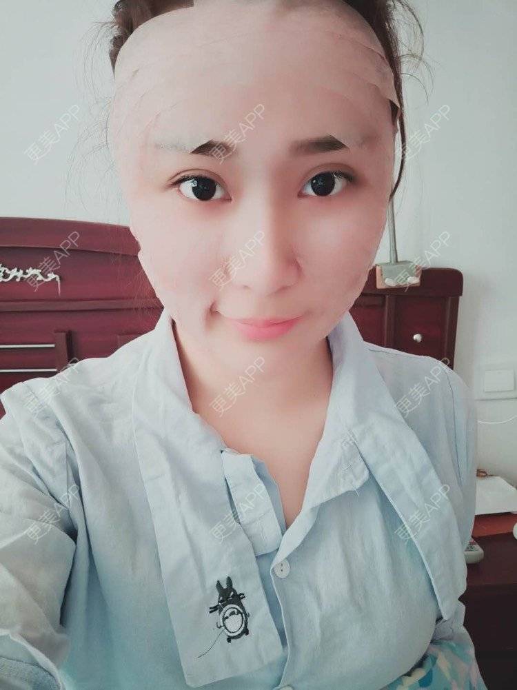 更美 - 更美用户IJkbsLYbyo的自体脂肪丰面颊经验 | 自体脂肪丰面颊 | 自体脂肪丰太阳穴 | 自体脂肪丰额头 | 合肥 | 自体脂肪全面部填充