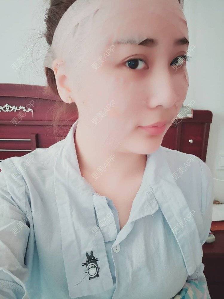 更美 - 更美用户IJkbsLYbyo的自体脂肪丰面颊经验 | 自体脂肪丰面颊 | 自体脂肪丰太阳穴 | 自体脂肪丰额头 | 合肥 | 自体脂肪全面部填充