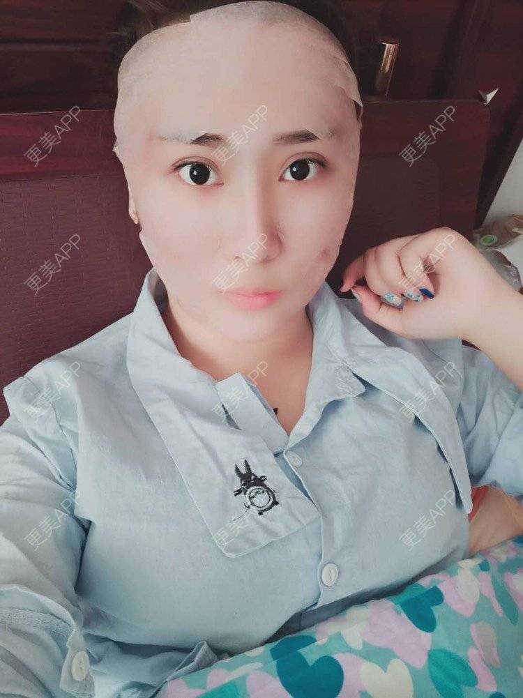 更美 - 更美用户IJkbsLYbyo的自体脂肪丰面颊经验 | 自体脂肪丰面颊 | 自体脂肪丰太阳穴 | 自体脂肪丰额头 | 合肥 | 自体脂肪全面部填充