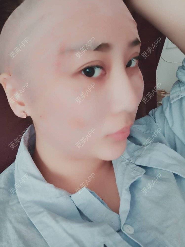 更美 - 更美用户IJkbsLYbyo的自体脂肪丰面颊经验 | 自体脂肪丰面颊 | 自体脂肪丰太阳穴 | 自体脂肪丰额头 | 合肥 | 自体脂肪全面部填充