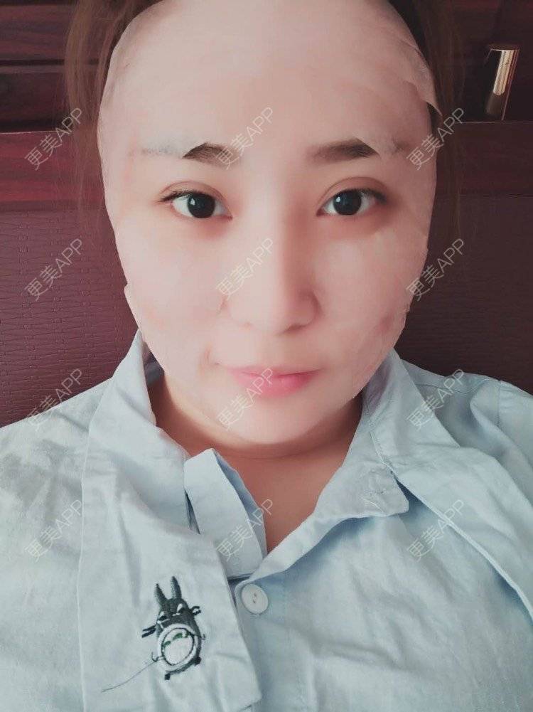 更美 - 更美用户IJkbsLYbyo的自体脂肪丰面颊经验 | 自体脂肪丰面颊 | 自体脂肪丰太阳穴 | 自体脂肪丰额头 | 合肥 | 自体脂肪全面部填充