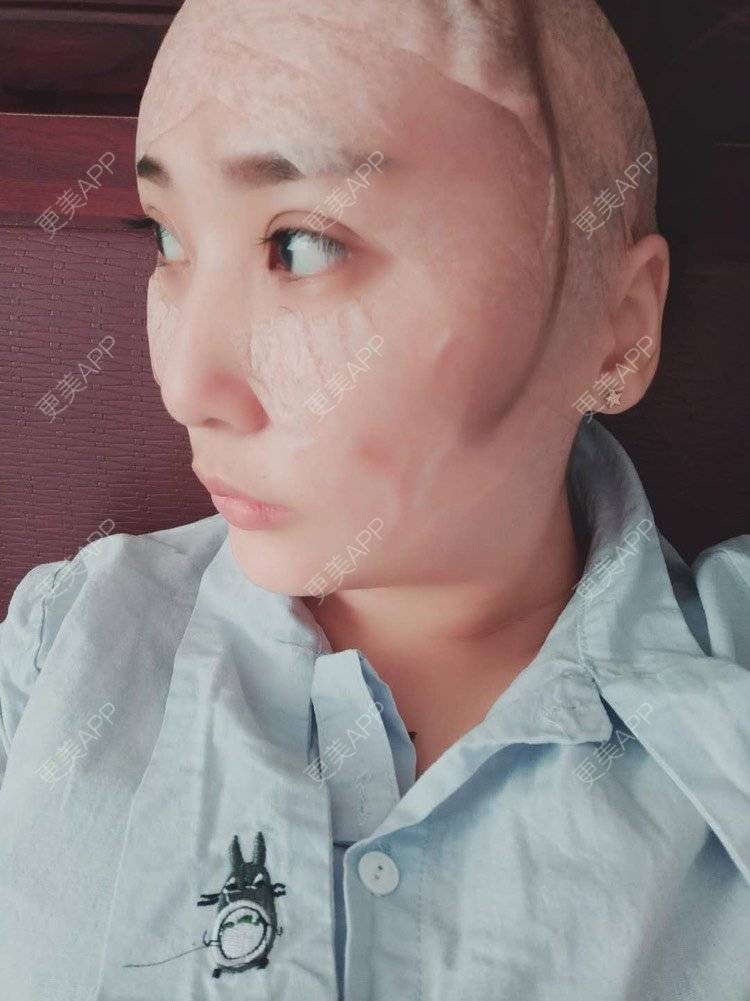 更美 - 更美用户IJkbsLYbyo的自体脂肪丰面颊经验 | 自体脂肪丰面颊 | 自体脂肪丰太阳穴 | 自体脂肪丰额头 | 合肥 | 自体脂肪全面部填充