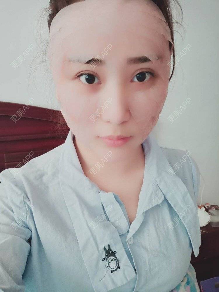 更美 - 更美用户IJkbsLYbyo的自体脂肪丰面颊经验 | 自体脂肪丰面颊 | 自体脂肪丰太阳穴 | 自体脂肪丰额头 | 合肥 | 自体脂肪全面部填充