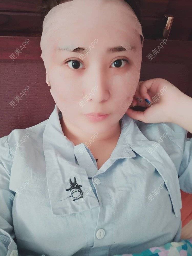 更美 - 更美用户IJkbsLYbyo的自体脂肪丰面颊经验 | 自体脂肪丰面颊 | 自体脂肪丰太阳穴 | 自体脂肪丰额头 | 合肥 | 自体脂肪全面部填充