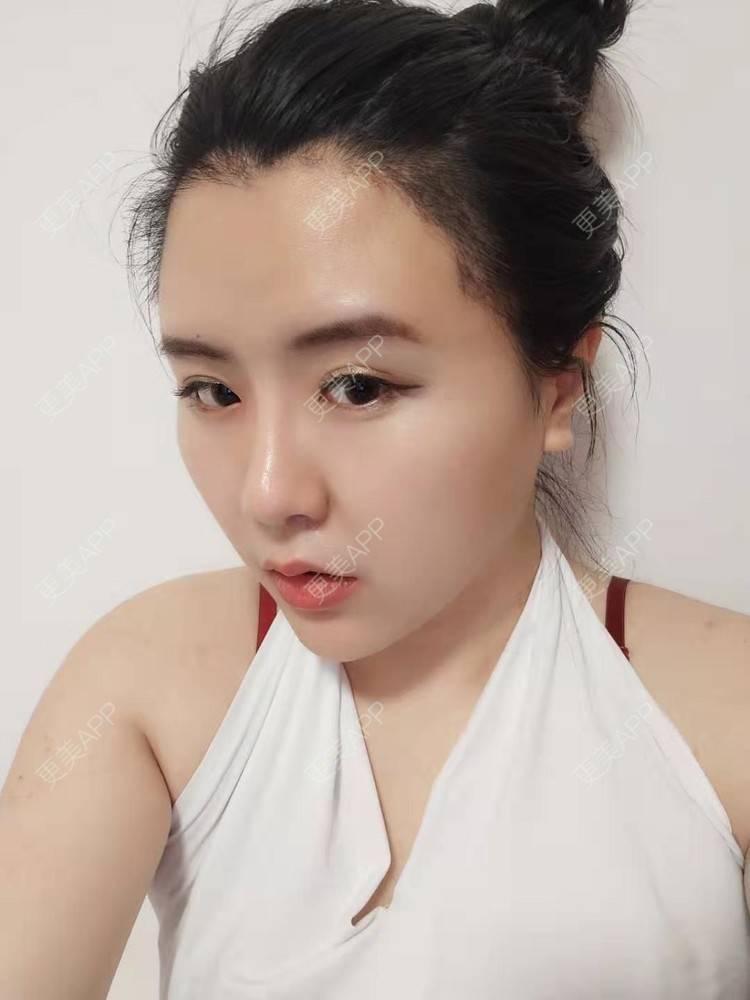 更美 - 更美用户YKZMRFxGOD的膨体垫眉弓经验 | 膨体垫眉弓 | 垫眉弓 | 武汉 | 硅胶垫眉弓