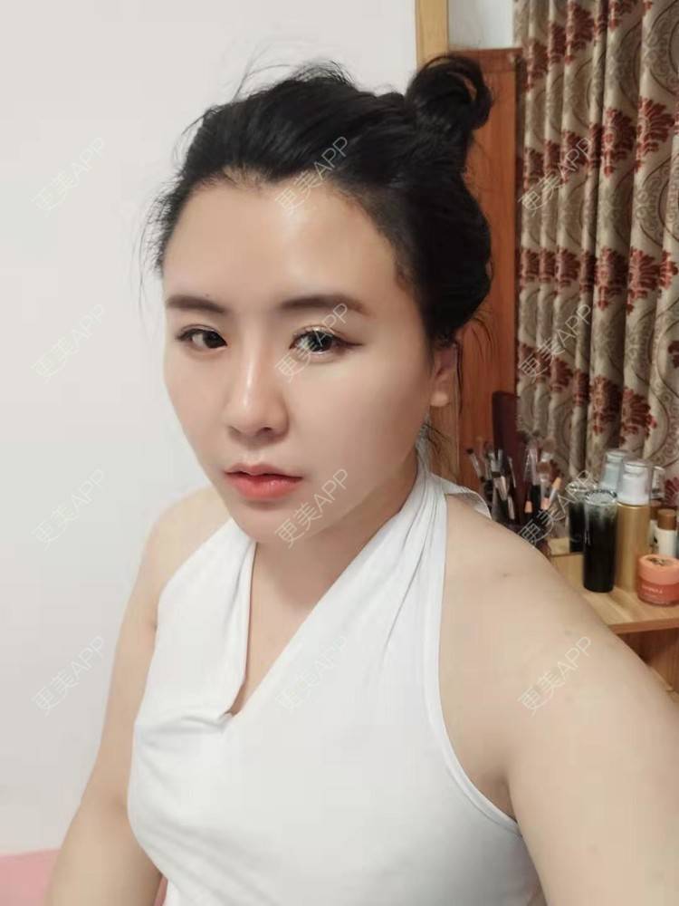 更美 - 更美用户YKZMRFxGOD的膨体垫眉弓经验 | 膨体垫眉弓 | 垫眉弓 | 武汉 | 硅胶垫眉弓