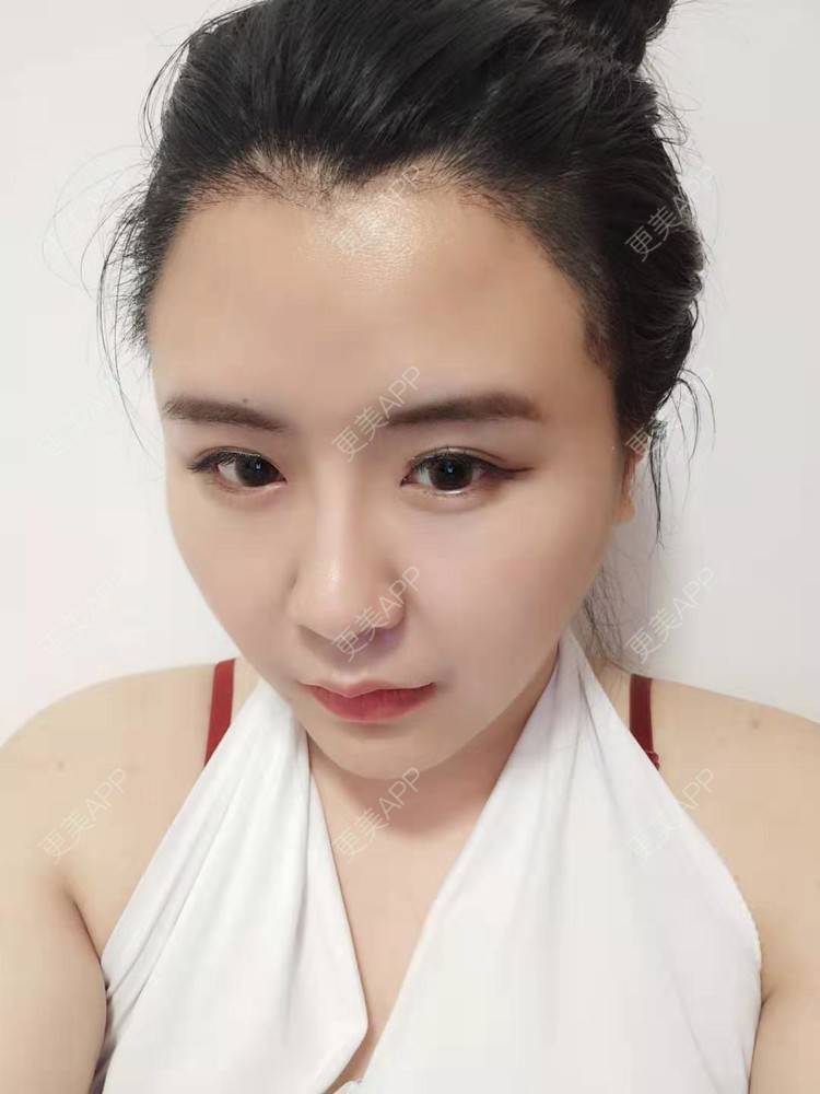 更美 - 更美用户YKZMRFxGOD的膨体垫眉弓经验 | 膨体垫眉弓 | 垫眉弓 | 武汉 | 硅胶垫眉弓
