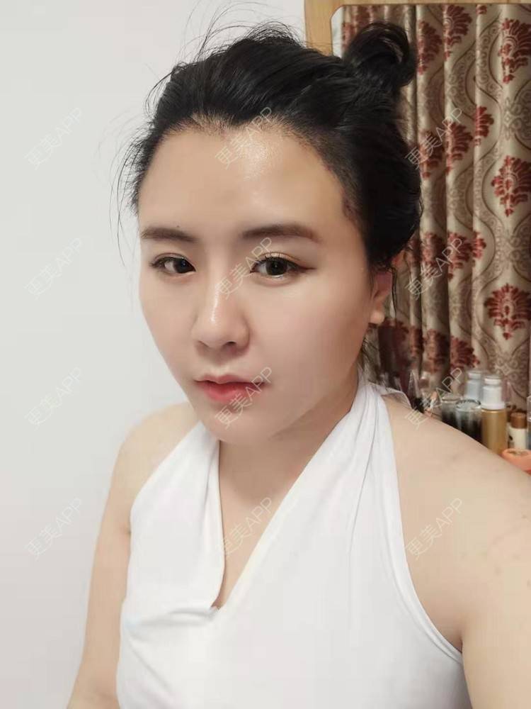 更美 - 更美用户YKZMRFxGOD的膨体垫眉弓经验 | 膨体垫眉弓 | 垫眉弓 | 武汉 | 硅胶垫眉弓