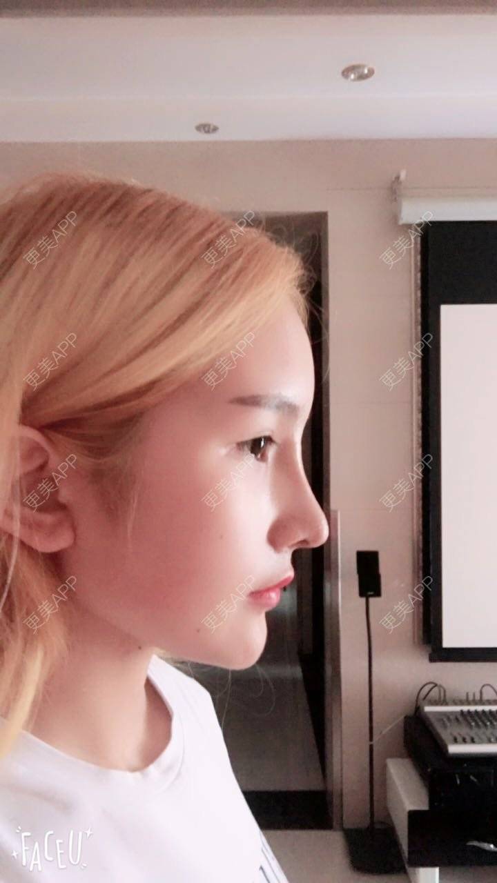 山丹丹花开喽的肋软骨隆鼻日记