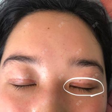 全切双眼皮肉条太明显