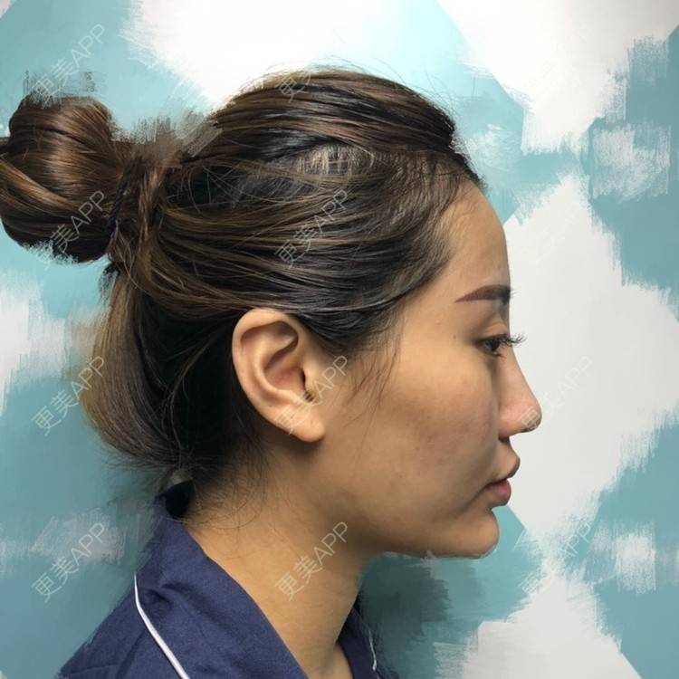 更美 - 昕昕117的自体脂肪填充泪沟经验 | 自体脂肪面部填充 | 自体脂肪填充泪沟 | 自体脂肪丰苹果肌 | 自体脂肪丰面颊 | 自体脂肪丰额头 | 自体脂肪丰太阳穴 | 自体脂肪全面部填充 | 视频日记
