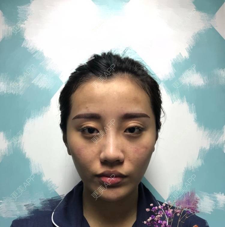 更美 - 昕昕117的自体脂肪填充泪沟经验 | 自体脂肪面部填充 | 自体脂肪填充泪沟 | 自体脂肪丰苹果肌 | 自体脂肪丰面颊 | 自体脂肪丰额头 | 自体脂肪丰太阳穴 | 自体脂肪全面部填充 | 视频日记
