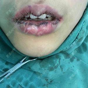 更美用户wtbmt0uwno的厚唇改薄术日记