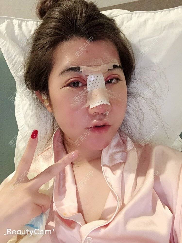 更美 - 更美用户0nPIycPEYh的全切双眼皮经验 | 耳软骨隆鼻 | 全切双眼皮 | 开内眼角 | 开外眼角 | 台州