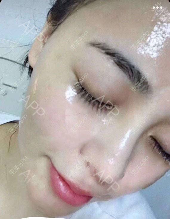 更美 - 更美用户cdThGj0yOv的微针水光经验 | 果酸焕肤 | 微针水光 | 南昌