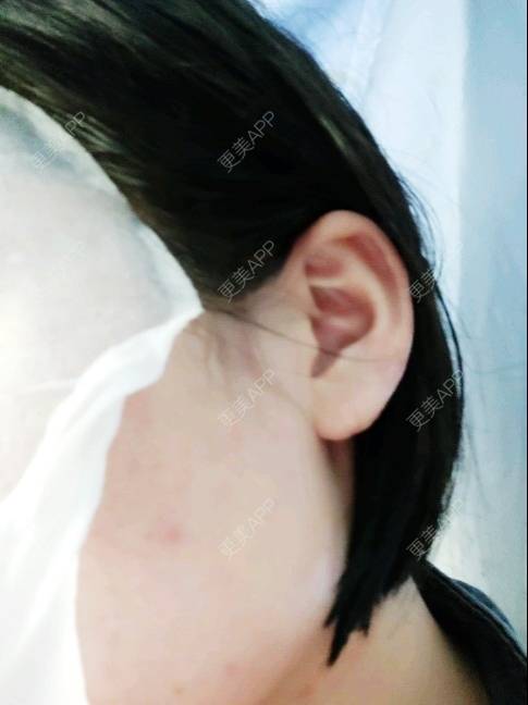 更美 - (๑乛◡乛๑)的除皱瘦脸经验 | 除皱瘦脸 | 南京