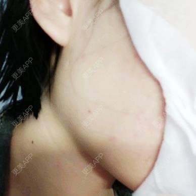 更美 - (๑乛◡乛๑)的除皱瘦脸经验 | 除皱瘦脸 | 南京