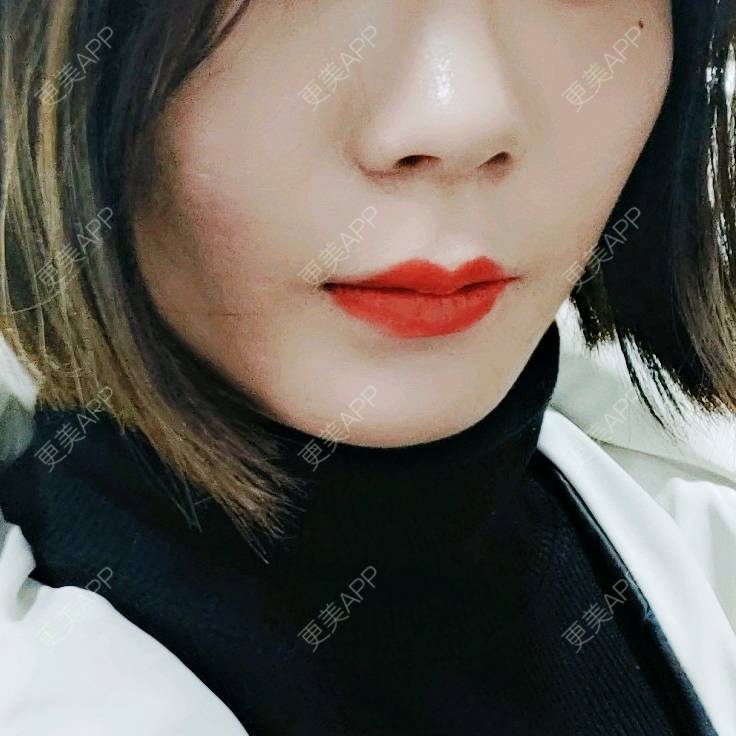 更美 - (๑乛◡乛๑)的除皱瘦脸经验 | 除皱瘦脸 | 南京