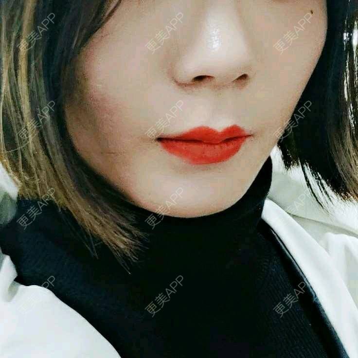 更美 - (๑乛◡乛๑)的除皱瘦脸经验 | 除皱瘦脸 | 南京