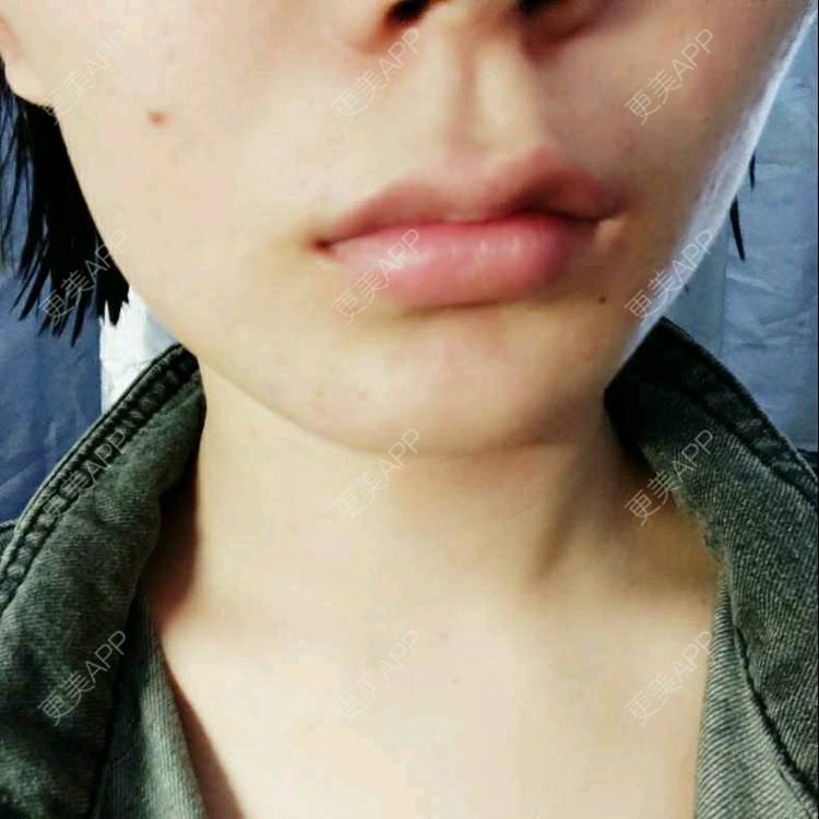 更美 - (๑乛◡乛๑)的除皱瘦脸经验 | 除皱瘦脸 | 南京