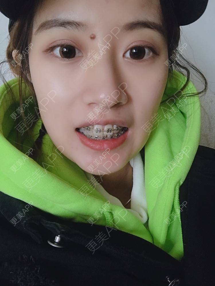 更美用户ov4fvqlov4的牙齿矫正日记