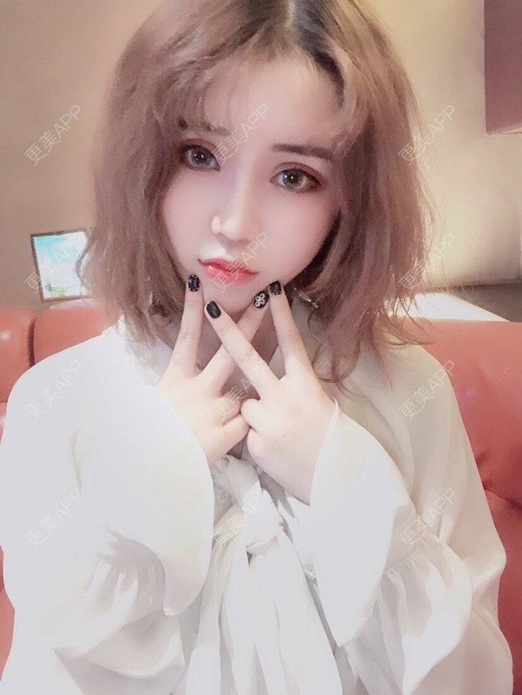 更美 - 幕大大的厚唇改薄经验 | 唇腭裂修复 | 开内眼角 | 开外眼角 | 厚唇改薄 | 玻尿酸唇部 | 自体脂肪丰唇 | 成都 | 注射美白 | M唇成形 | 超声提升 | 半永久妆 | 唇综合