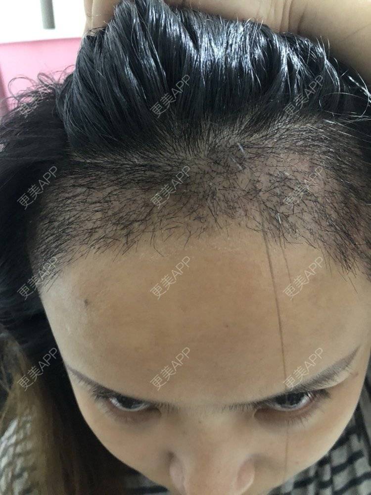 更美 - 奥多Ke。的植发际线经验 | 植发际线 | 南昌