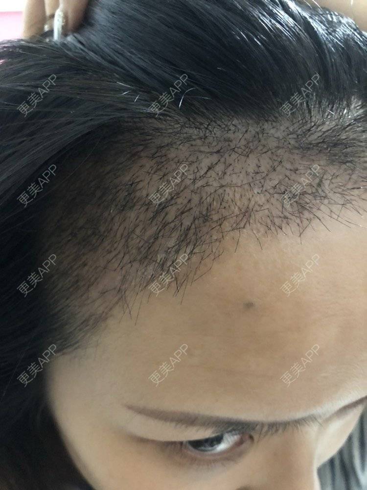 更美 - 奥多Ke。的植发际线经验 | 植发际线 | 南昌