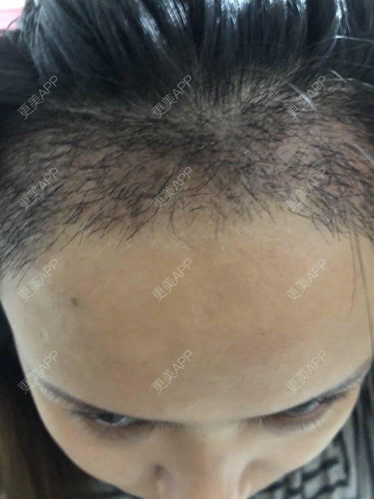 更美 - 奥多Ke。的植发际线经验 | 植发际线 | 南昌