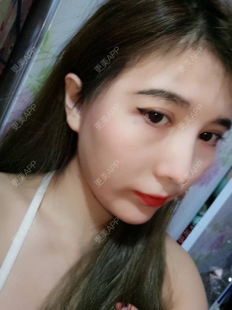 更美 - 美少女特工队的硅胶丰太阳穴经验 | 太阳穴 | 硅胶丰太阳穴 | 膨体丰太阳穴 | 武汉