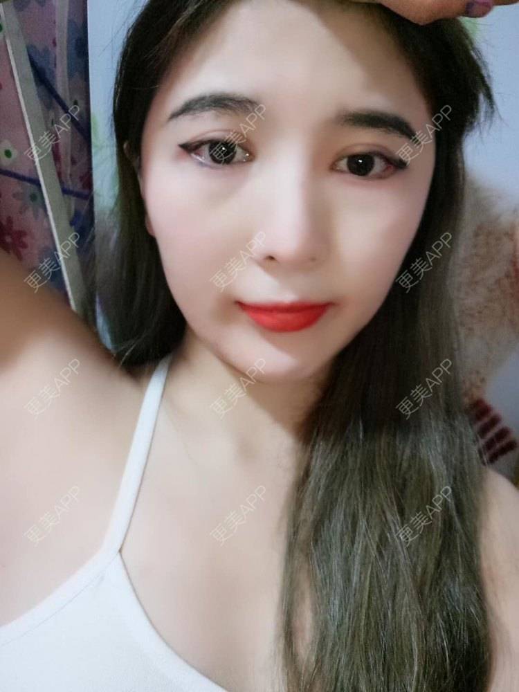 更美 - 美少女特工队的硅胶丰太阳穴经验 | 太阳穴 | 硅胶丰太阳穴 | 膨体丰太阳穴 | 武汉