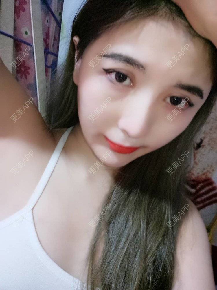 更美 - 美少女特工队的硅胶丰太阳穴经验 | 太阳穴 | 硅胶丰太阳穴 | 膨体丰太阳穴 | 武汉