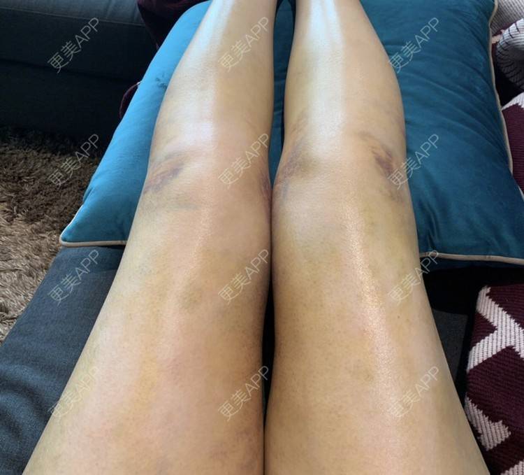 臀部 | 吸脂塑臀 | 吸脂 | 吸脂瘦大腿 | 腿部塑形 | 温州