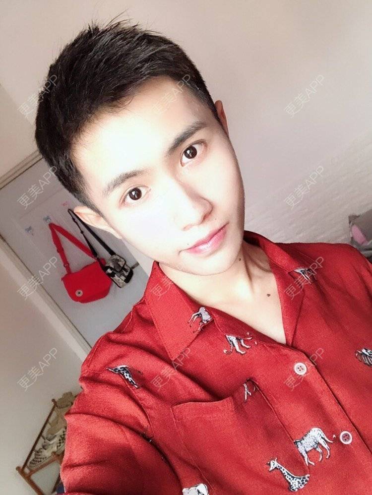 更美 - Ewww时的面部脱毛经验 | 厚唇改薄 | 唇综合 | 唇腭裂修复 | 隆鼻 | 面部脱毛 | 玻尿酸唇部 | 成都 | 注射美白 | 超声提升 | 半永久妆 | 视频日记