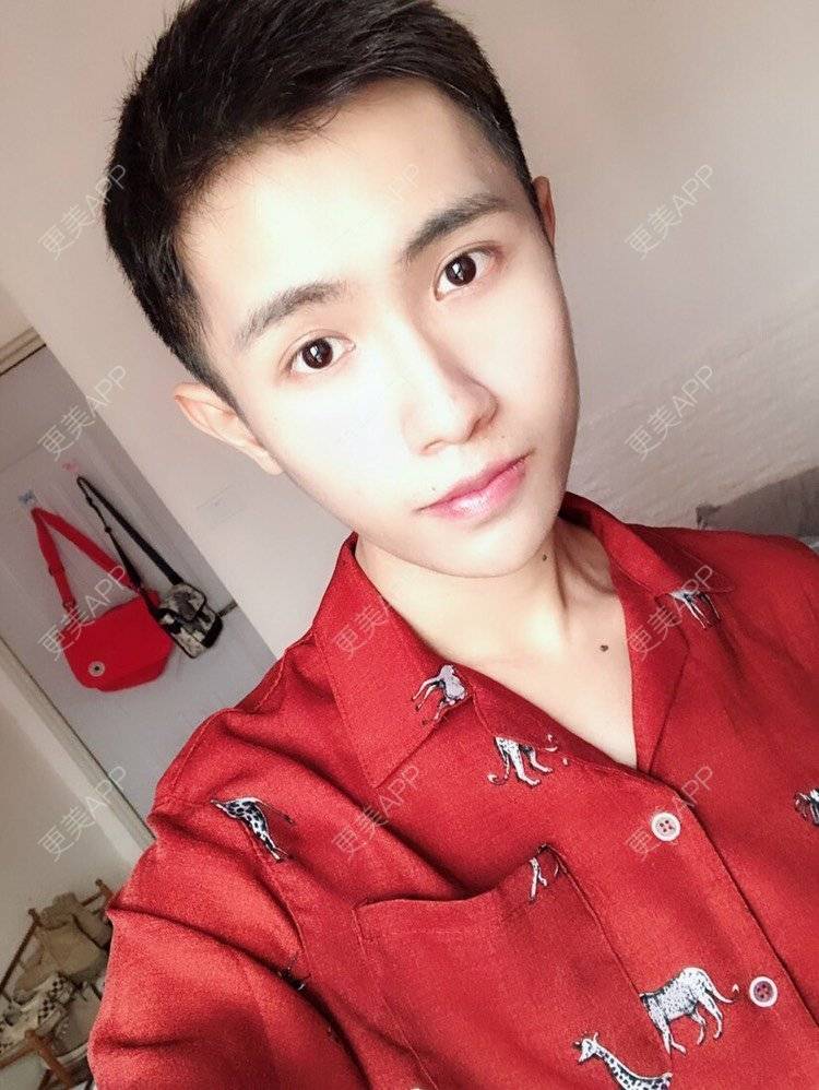 更美 - Ewww时的面部脱毛经验 | 厚唇改薄 | 唇综合 | 唇腭裂修复 | 隆鼻 | 面部脱毛 | 玻尿酸唇部 | 成都 | 注射美白 | 超声提升 | 半永久妆 | 视频日记