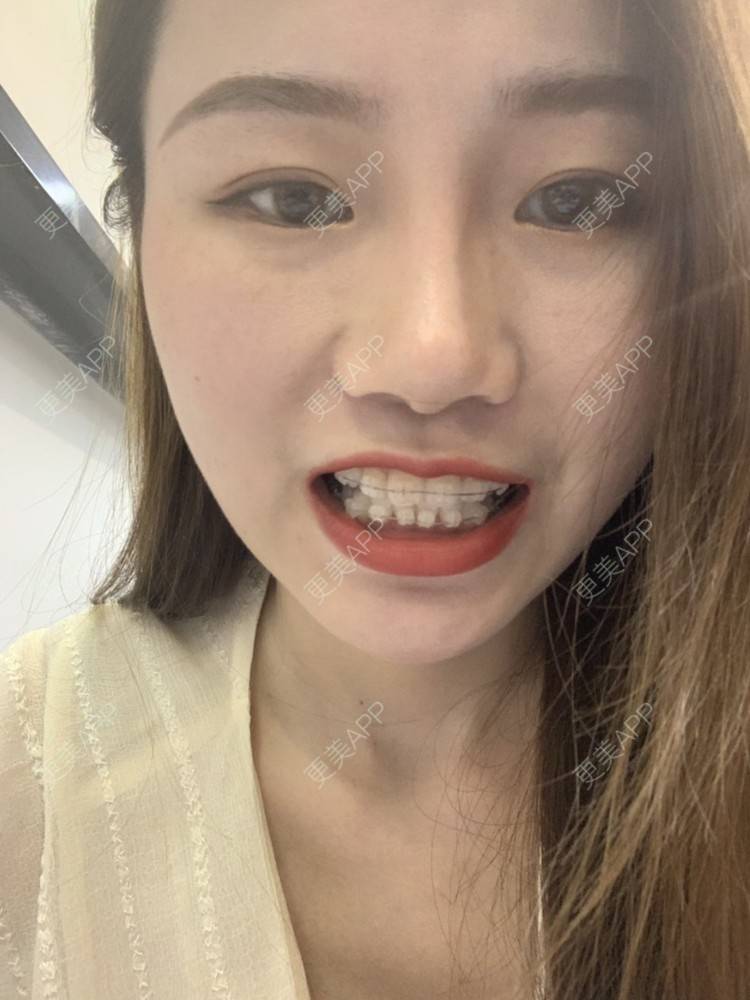 更美 - ahah的牙齿矫正经验 | 牙齿矫正 | 广州