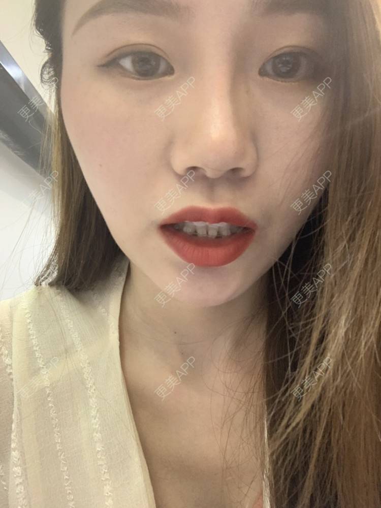 更美 - ahah的牙齿矫正经验 | 牙齿矫正 | 广州