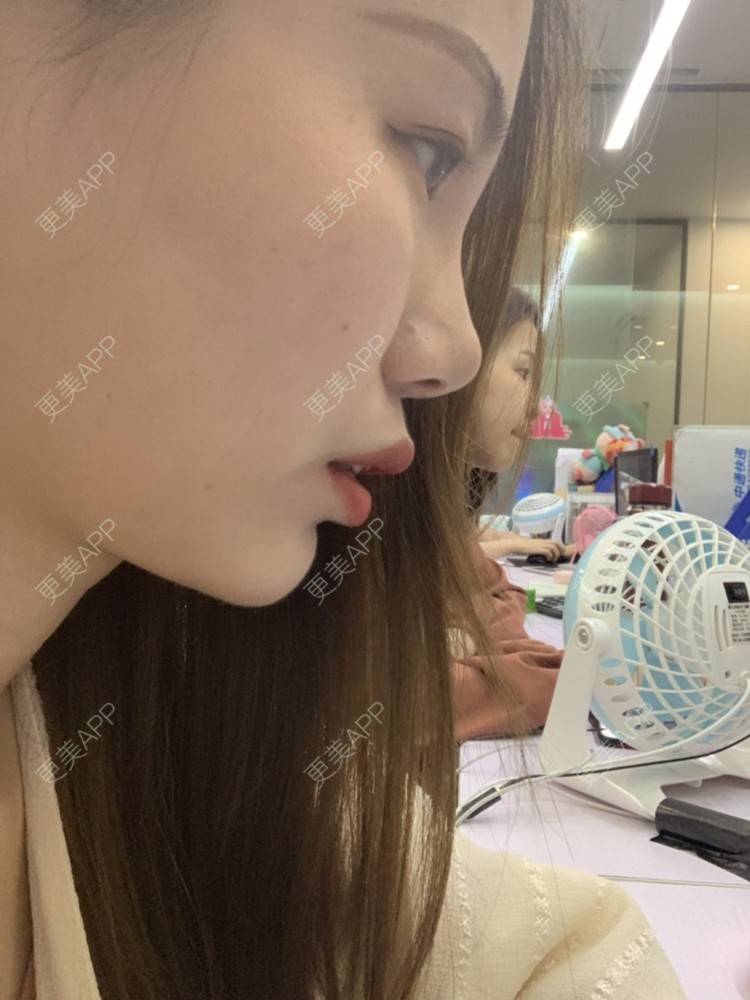更美 - ahah的牙齿矫正经验 | 牙齿矫正 | 广州