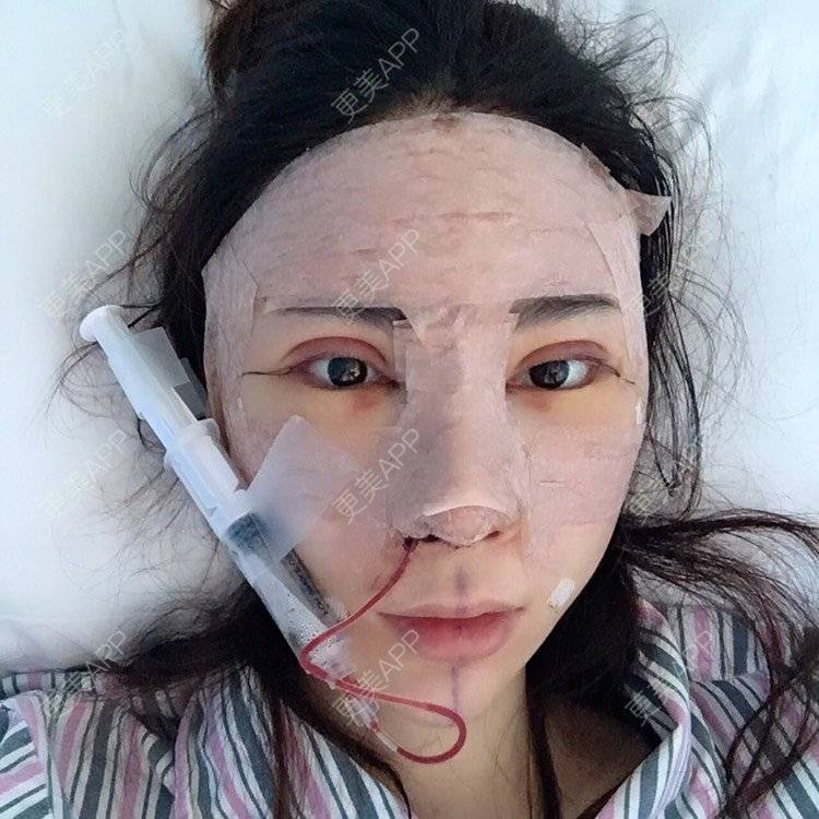 更美 - 更美用户amzIQiOcdr的鼻部膨体假体取出经验 | 肋软骨隆鼻 | 鼻部膨体假体取出 | 自体肋软骨垫鼻基底 | 全脸整形套餐