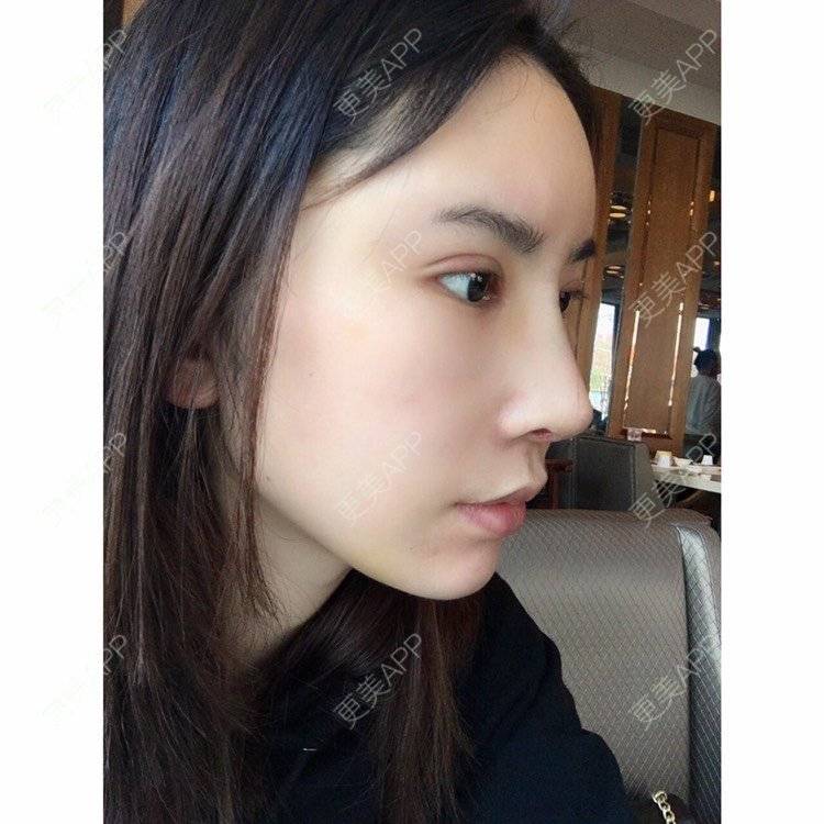 更美 - 更美用户amzIQiOcdr的鼻部膨体假体取出经验 | 肋软骨隆鼻 | 鼻部膨体假体取出 | 自体肋软骨垫鼻基底 | 全脸整形套餐