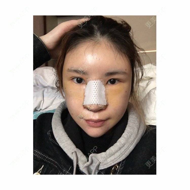 更美 - 更美用户amzIQiOcdr的鼻部膨体假体取出经验 | 肋软骨隆鼻 | 鼻部膨体假体取出 | 自体肋软骨垫鼻基底 | 全脸整形套餐