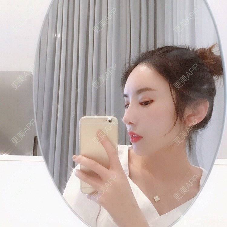 更美 - 更美用户amzIQiOcdr的鼻部膨体假体取出经验 | 肋软骨隆鼻 | 鼻部膨体假体取出 | 自体肋软骨垫鼻基底 | 全脸整形套餐