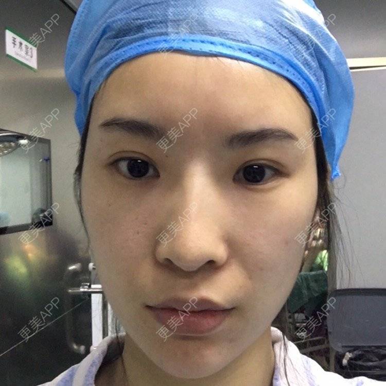 更美 - 更美用户amzIQiOcdr的鼻部膨体假体取出经验 | 肋软骨隆鼻 | 鼻部膨体假体取出 | 自体肋软骨垫鼻基底 | 全脸整形套餐