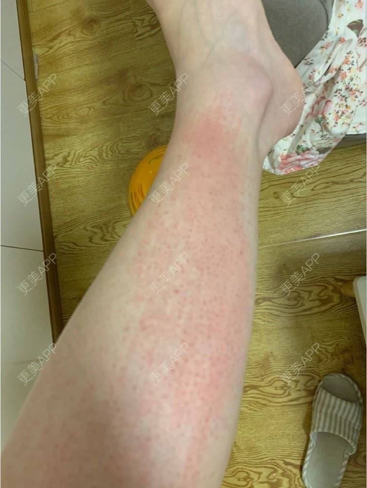 更美用户gjxfhi4ahb的激光脱毛日记