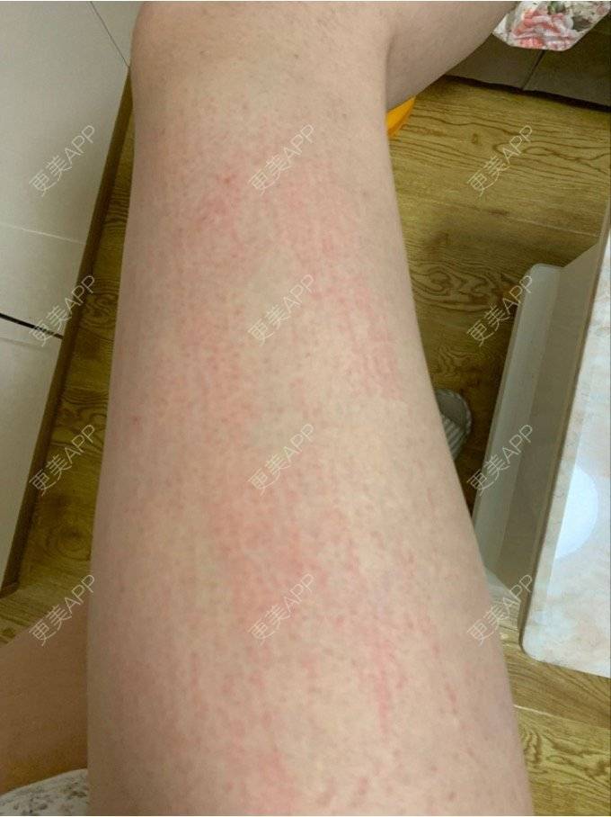 更美用户gjxfhi4ahb的激光脱毛日记