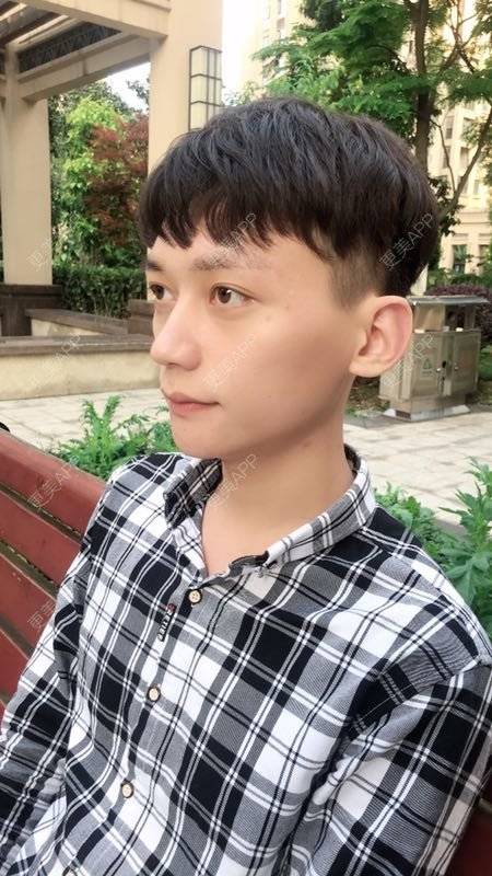 更美 - 幽默的超人的玻尿酸下巴经验 | 玻尿酸下巴 | 自体脂肪垫下巴 | 硅胶垫下巴 | 膨体垫下巴 | 胶原蛋白丰下巴 | 重庆