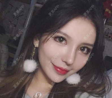 更美 - 大麦微针植发丨全国连锁(昆明分院)的鼻部综合经验 | 鼻部综合 | 武汉