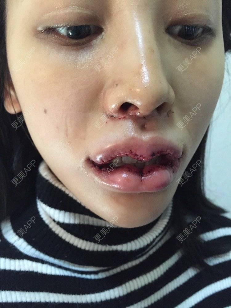 摩羯蓝蓝的的m唇成形术日记