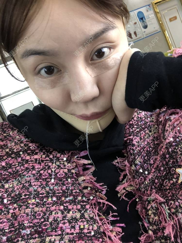 更美 - 炫雅的小迷妹💗的真皮丰卧蚕经验 | 真皮丰卧蚕 | 武汉